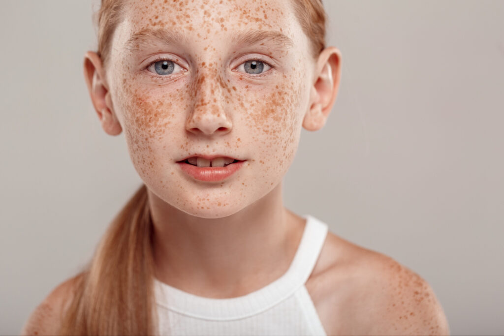 Inclusive Beauty. Girl with freckles and ponytail standing isolated on grey smilign excited close-up