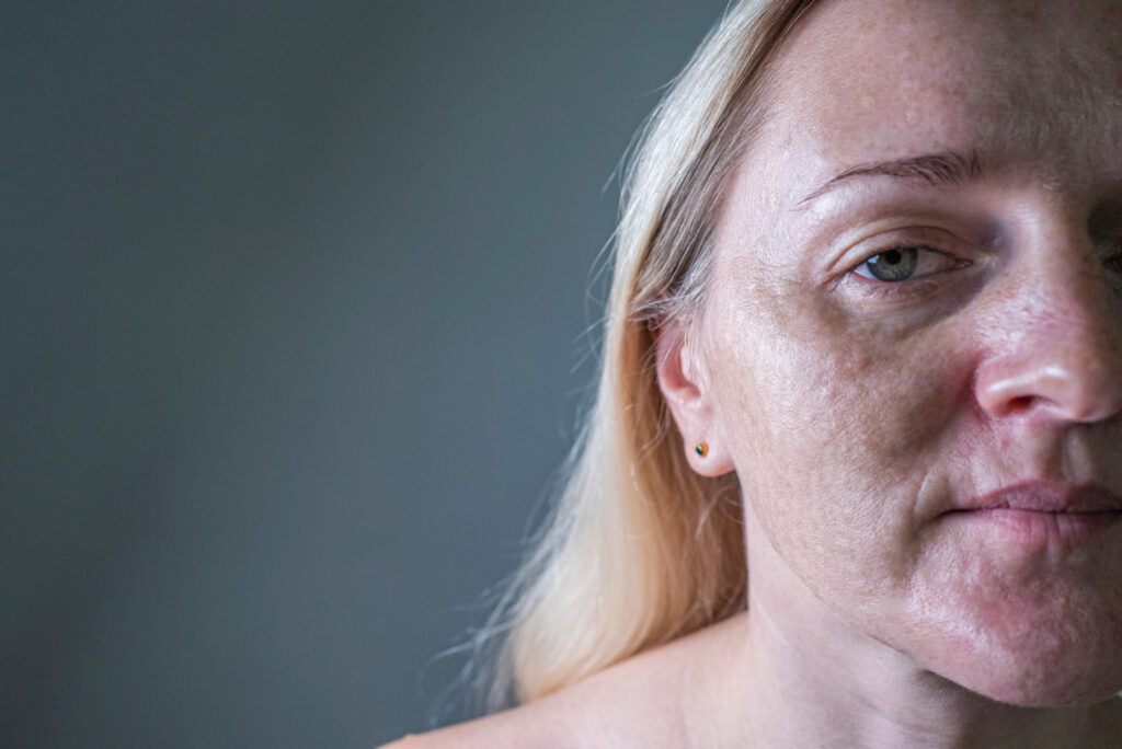 Real biorevitalization of the skin on a white background. Traces of injections of biorevitalization on the face of a woman. Traces of biorevitalization needles