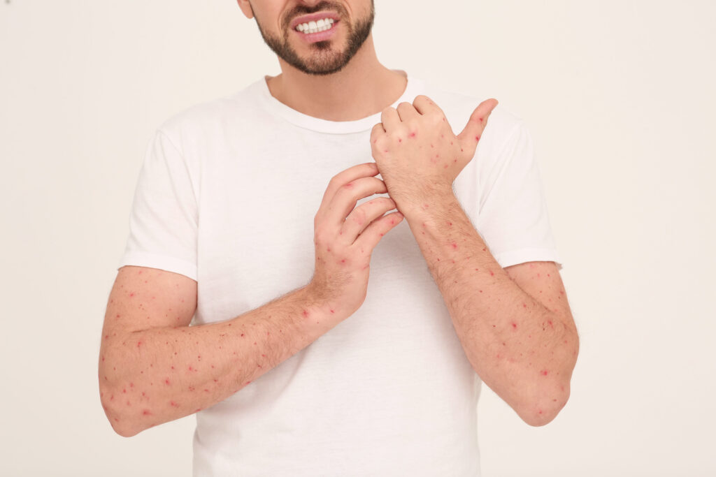 Smallpox
