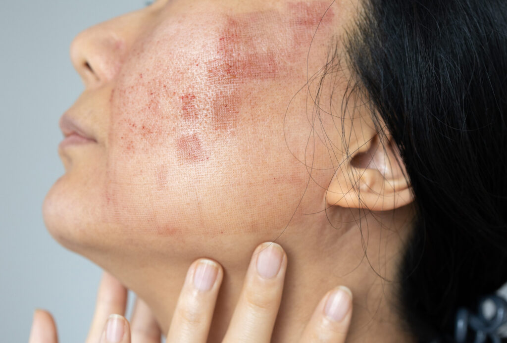 A face of Asian woman who had facial skin treatment by Co2 laser to treat her Acne Scars to get face smooth. Laser can solve this problem